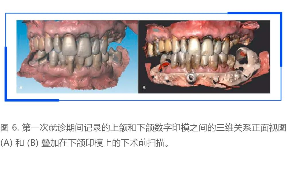 利用口腔掃描儀進行術前口內掃描和數字化設計